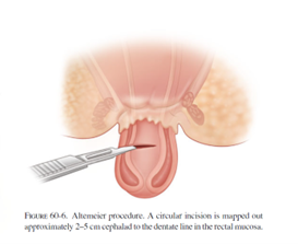 ALT-PROCEDURE.png ALT-PROCEDURE.png