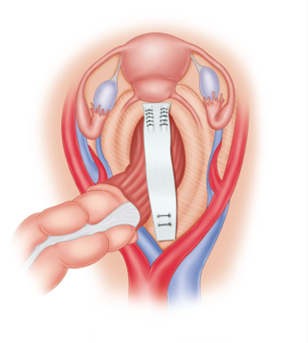 VENTRAL-RECTOPEXY.png VENTRAL-RECTOPEXY.png